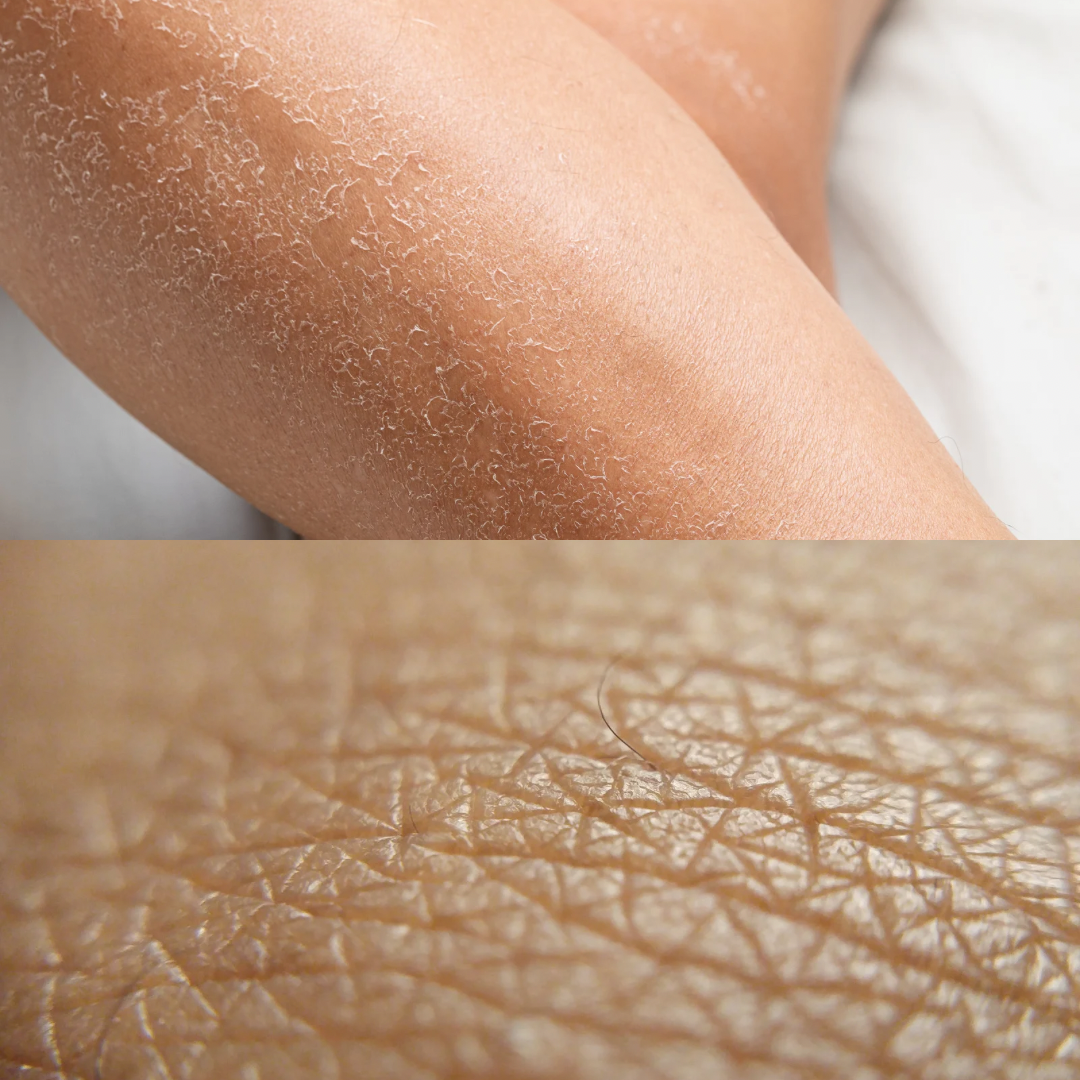 Your Skin Isn’t Just Dry—It’s Dehydrated. Here’s the Difference (and How to Treat Both)